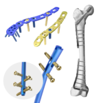 Osteosíntesis